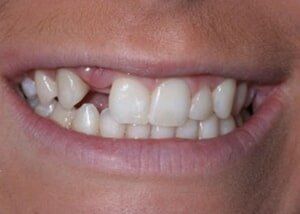 Dental implant to replace missing lateral - Before — Teeth and Gums in Lincolnton, NC