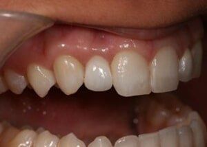 Dental implant to replace missing lateral - After — Teeth and Gums in Lincolnton, NC