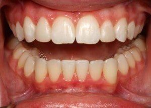 Bonding for “peg laterals” - After — Teeth and Gums in Lincolnton, NC
