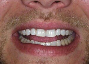 Bonding to close diastema - After — Teeth and Gums in Lincolnton, NC