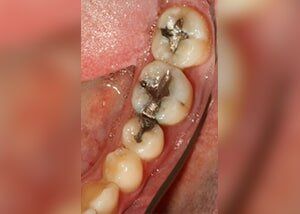 Porcelain crown and composite fillings to replace old silver fillings - Before — Teeth and Gums in Lincolnton, NC