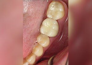 Porcelain crown and composite fillings to replace old silver fillings - After — Teeth and Gums in Lincolnton, NC