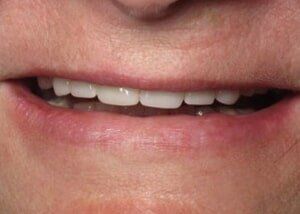 All porcelain crowns to restore smile - After — Teeth and Gums in Lincolnton, NC