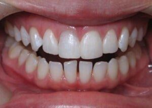 Cosmetic bonding to close spacing - After — Teeth and Gums in Lincolnton, NC