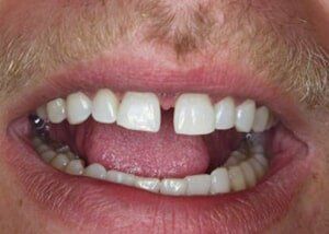 Bonding to close diastema - Before — Teeth and Gums in Lincolnton, NC