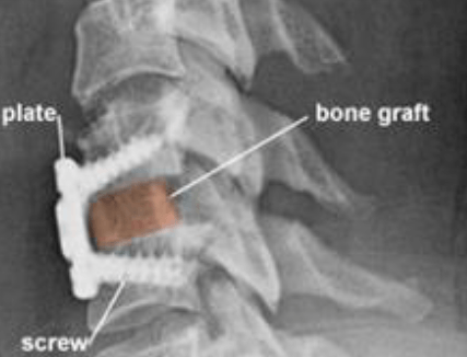 ACDF x ray image interior ACDF x ray image interior