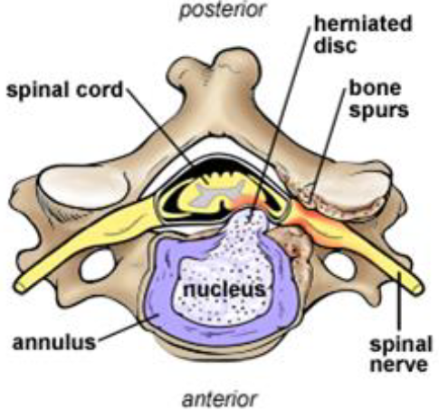 ACDF Spinal Fusion Interior ACDF Spinal Fusion Interior