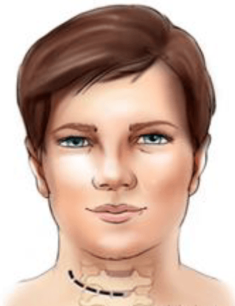 ACDF Image 2 Neck Photo ACDF Image 2 Neck Photo