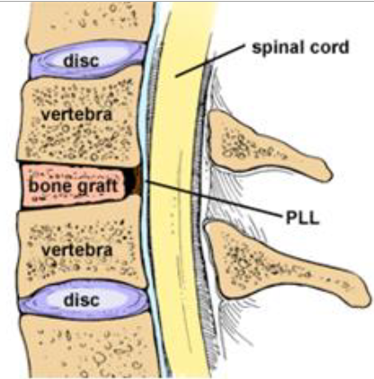 ACDF Spinal Fusion Interior Illustration ACDF Spinal Fusion Interior Illustration
