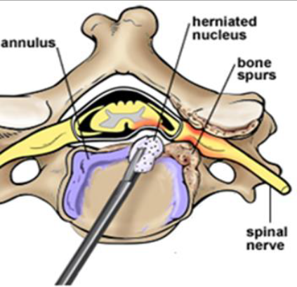 ACDF Spinal Fusion Interior View ACDF Spinal Fusion Interior View