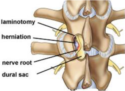 Laminotomy Graphic Laminotomy Graphic