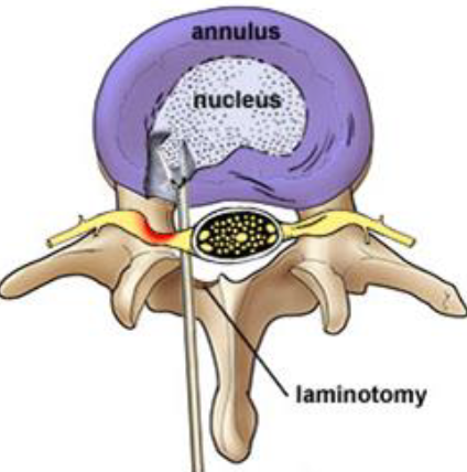 Discectomy Herniated Disk Image Discectomy Herniated Disk Image