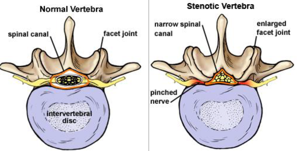 Laminotomy Laminectomy Illustration Laminotomy Laminectomy Illustration