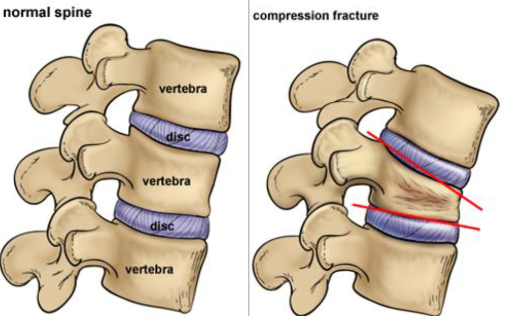Kyphoplasty Illustration Kyphoplasty Illustration