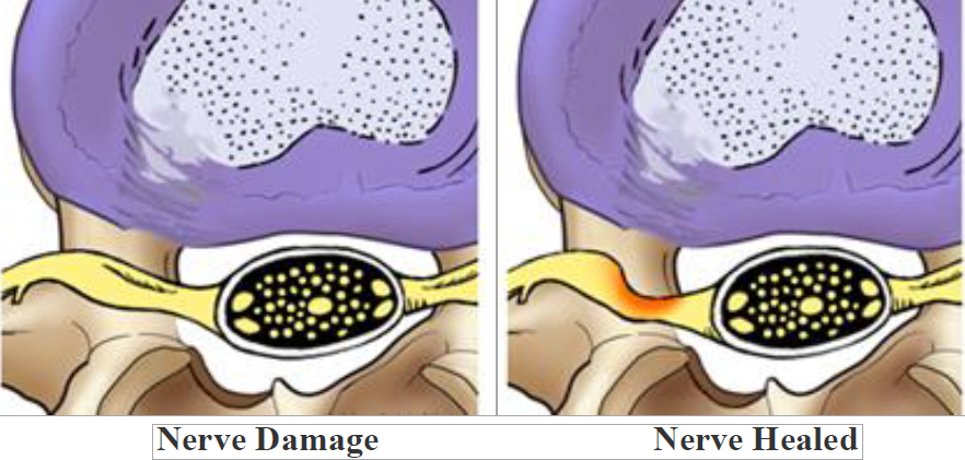 Nerve Damage Healed By Discectomy Nerve Damage Healed By Discectomy
