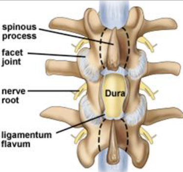 Laminotomy Laminectomy Illustration Laminotomy Laminectomy Illustration