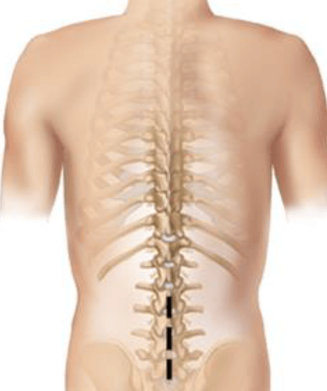 Laminotomy Laminectomy Illustration Laminotomy Laminectomy Illustration