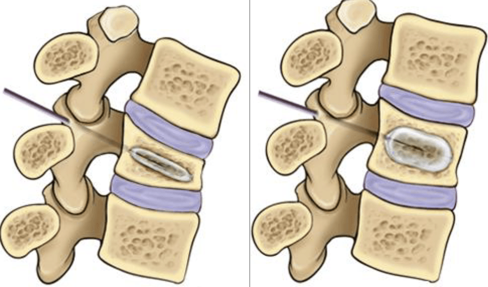 kyphoplasty illustration internal kyphoplasty illustration internal