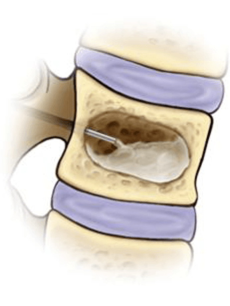 Kyphoplasty Illustration Internal Kyphoplasty Illustration Internal