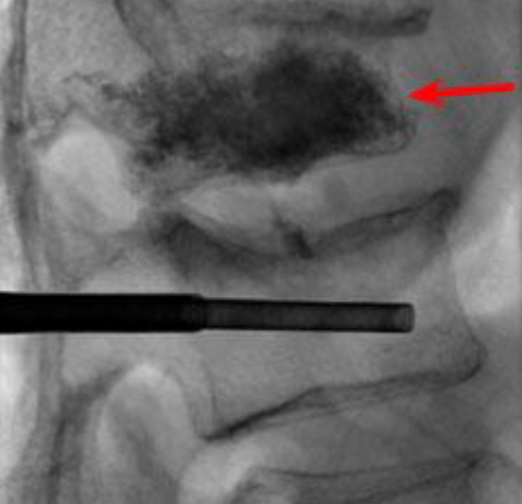 Kyphoplasty x ray 2 Kyphoplasty x ray 2