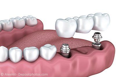 Eine Zahnbrücke kann mit Implantaten befestigt werden Eine Zahnbrücke kann mit Implantaten befestigt werden