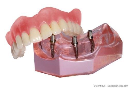 Befestigung von Vollprothesen mit Implantaten Befestigung von Vollprothesen mit Implantaten