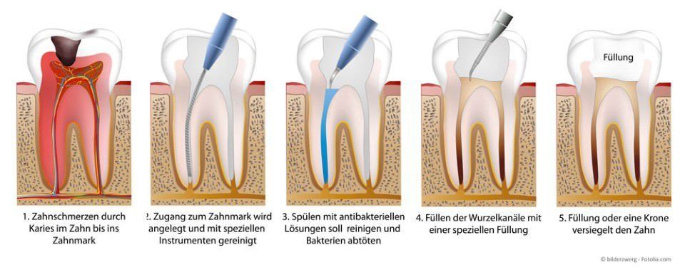 Der Ablauf einer Wurzelkanalbehandlung