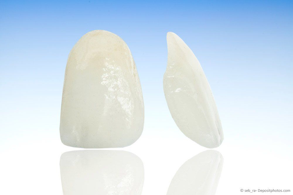 Veneers - hauchdünne Verblendschalen Veneers - hauchdünne Verblendschalen