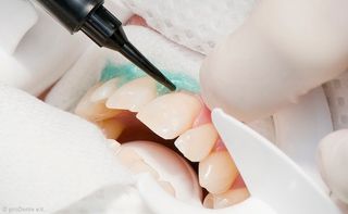 Power-Bleaching: Zahnfleischschutz Power-Bleaching: Zahnfleischschutz