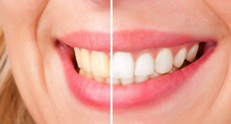 before and after teeth whitening