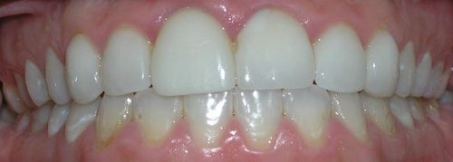 A close up of a person 's teeth with white teeth.