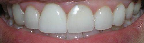 A close up of a person 's teeth with white teeth.