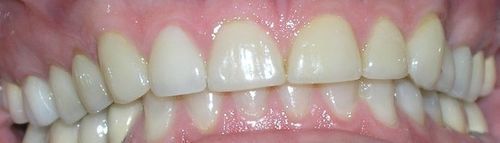 A close up of a person 's teeth with white teeth.