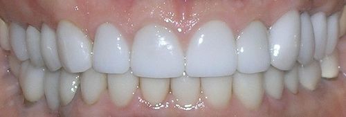 A close up of a person 's teeth with white teeth.