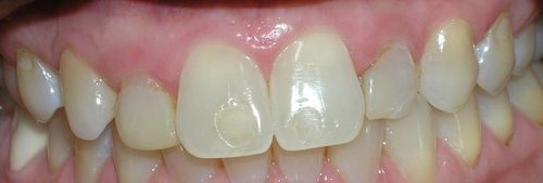 A close up of a person 's teeth with white teeth.
