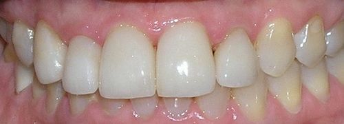 A close up of a person 's teeth with white teeth.