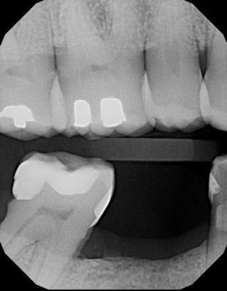 A black and white photo of a person 's teeth