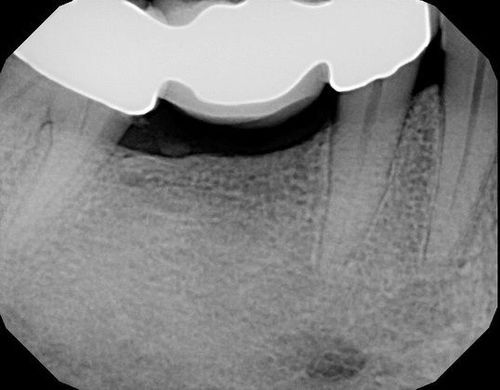 A black and white x-ray of a tooth with a white outline around it.