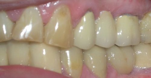 A close up of a person 's teeth and gums.