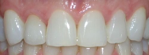 A close up of a person 's teeth with white teeth.