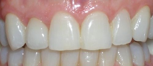 A close up of a person 's teeth with white teeth.