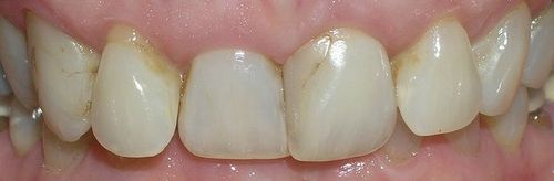 A close up of a person 's teeth with yellow spots on them.