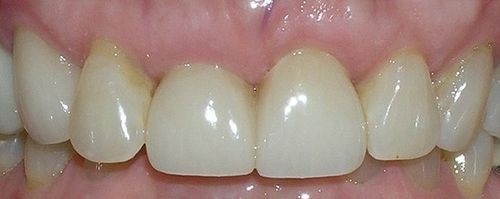 A close up of a person 's teeth with white teeth.