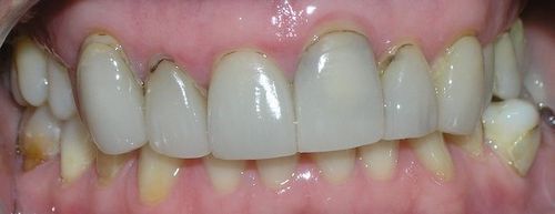 A close up of a person 's teeth with a broken tooth.