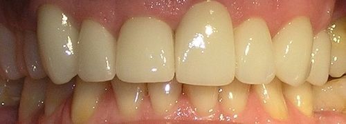 A close up of a person 's teeth with white teeth.