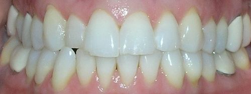 A close up of a person 's teeth with a missing tooth.