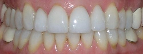 A close up of a person 's teeth with white teeth.