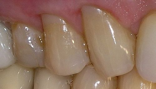 A close up of a person 's teeth and gums.