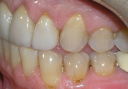 A close up of a person 's teeth with a pink gums.
