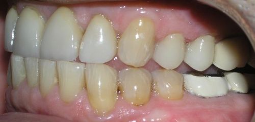 A close up of a person 's teeth with a missing tooth.